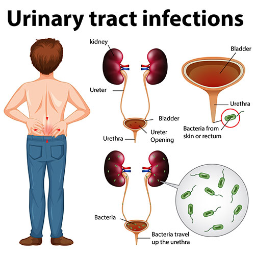Urinary Tract Infection In Men